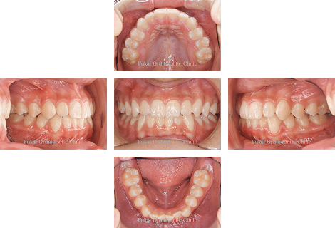 ガタガタ(叢生)− 症例2の写真