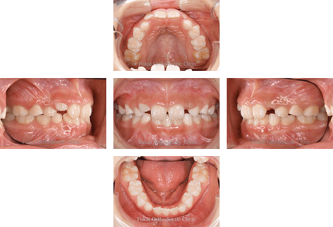 ガタガタ(叢生)− 症例2の写真