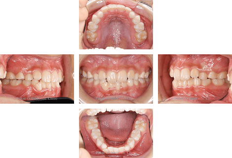 ガタガタ(叢生)− 症例2の写真