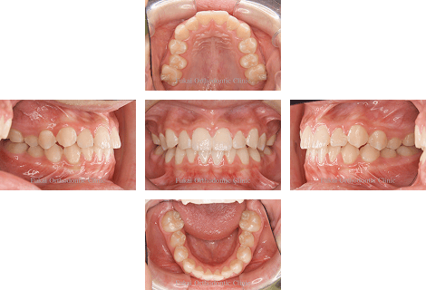 ガタガタ(叢生)− 症例3の写真