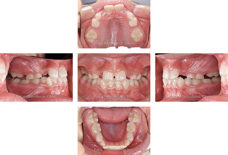 ガタガタ(叢生)− 症例3の写真