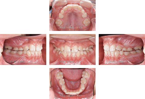 ガタガタ(叢生)− 症例3の写真
