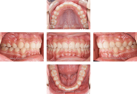 出っ歯(上顎前突)− 症例1の写真