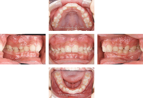 出っ歯(上顎前突)− 症例1の写真