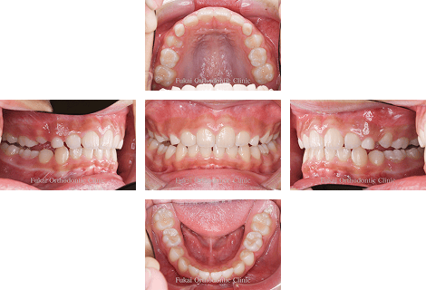 出っ歯(上顎前突)− 症例1の写真