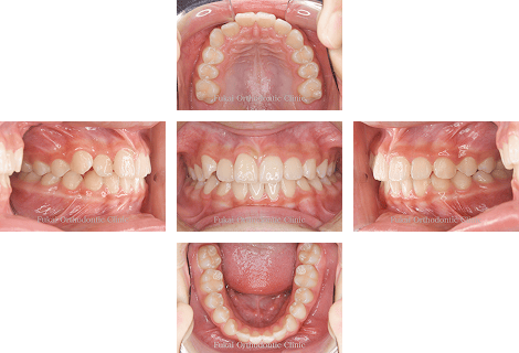 出っ歯(上顎前突)− 症例2の写真