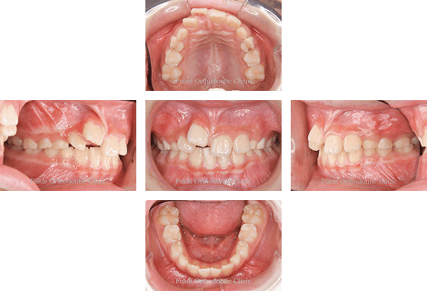出っ歯(上顎前突)− 症例2の写真