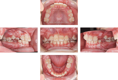出っ歯(上顎前突)− 症例2の写真