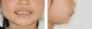 出っ歯(上顎前突)− 症例3の写真