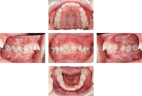 出っ歯(上顎前突)− 症例3の写真