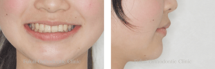 出っ歯(上顎前突)− 症例3の写真