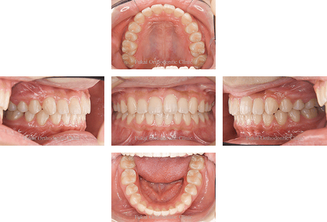 出っ歯(上顎前突)− 症例3の写真