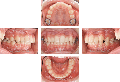 出っ歯(上顎前突)− 症例3の写真