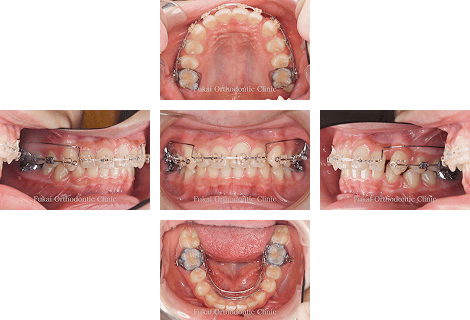 出っ歯(上顎前突)− 症例3の写真