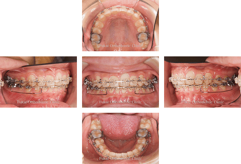 出っ歯(上顎前突)− 症例3の写真