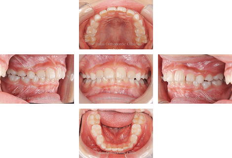 出っ歯(上顎前突)− 症例3の写真