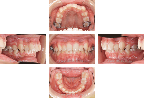 出っ歯(上顎前突)− 症例3の写真