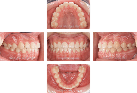 受け口-(下顎前突)− 症例1の写真