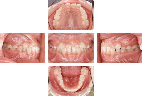 受け口-(下顎前突)− 症例1の写真
