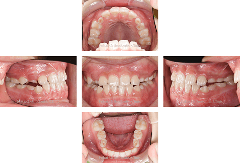 受け口-(下顎前突)− 症例1の写真