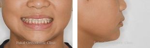 受け口-(下顎前突)− 症例2の写真