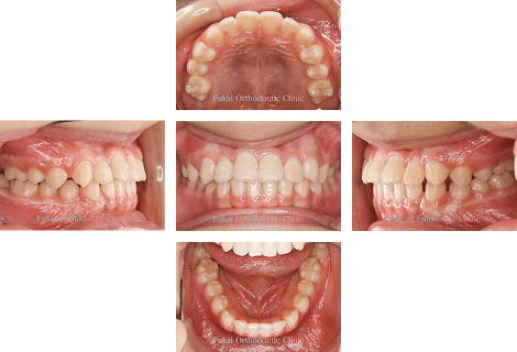 受け口-(下顎前突)− 症例2の写真