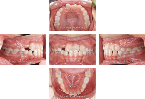 受け口-(下顎前突)− 症例2の写真