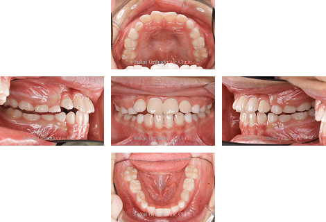 受け口-(下顎前突)− 症例2の写真