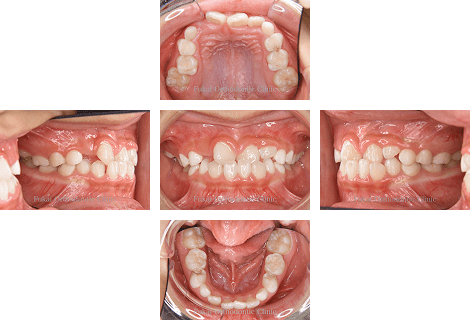 受け口-(下顎前突)− 症例3の写真