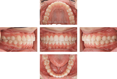 受け口-(下顎前突)− 症例3の写真