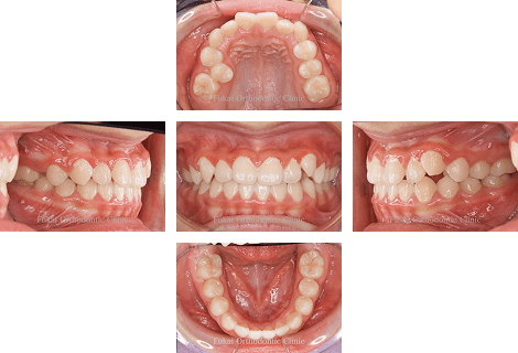 受け口-(下顎前突)− 症例3の写真