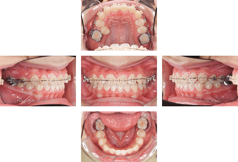 受け口-(下顎前突)− 症例3の写真