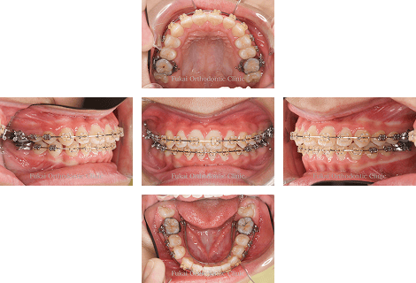 受け口-(下顎前突)− 症例3の写真