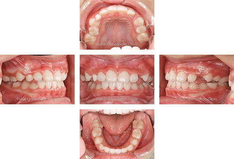 受け口-(下顎前突)− 症例3の写真