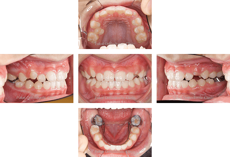 受け口-(下顎前突)− 症例3の写真