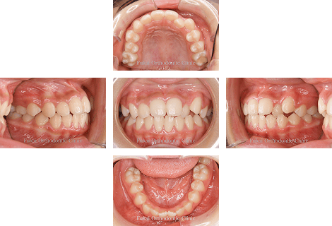 開咬− 症例1の写真
