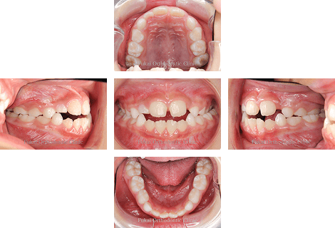 開咬− 症例1の写真