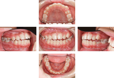 開咬− 症例1の写真