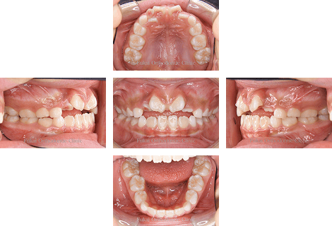 開咬− 症例3の写真