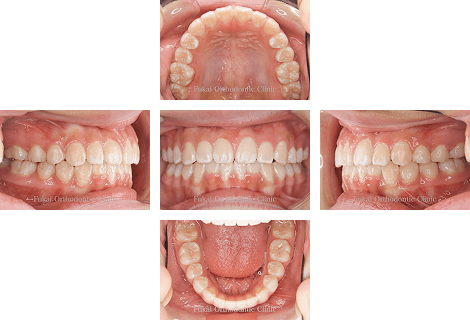開咬− 症例3の写真