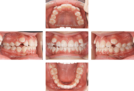 開咬− 症例3の写真