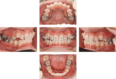 開咬− 症例3の写真
