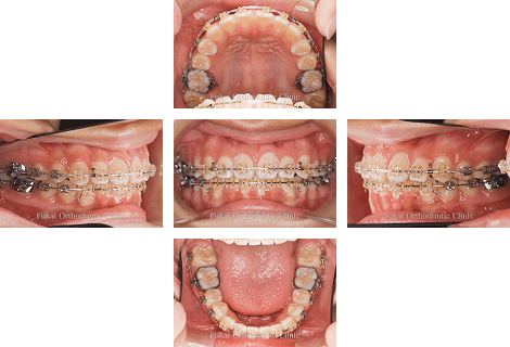 開咬− 症例3の写真