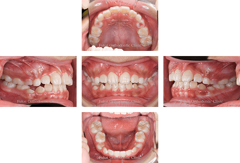 開咬− 症例3の写真