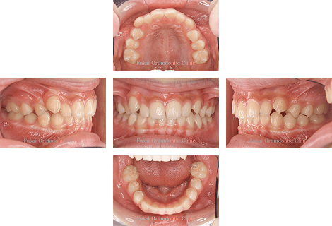 埋伏歯− 症例1の写真