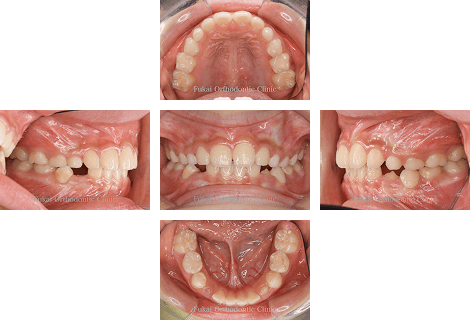 埋伏歯− 症例1の写真