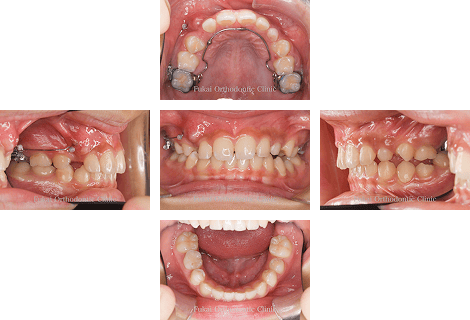 埋伏歯− 症例1の写真