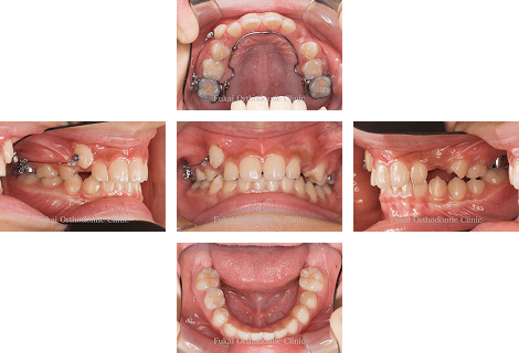 埋伏歯− 症例1の写真