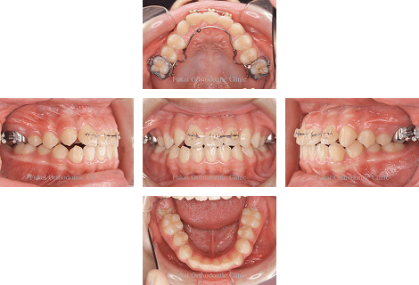埋伏歯− 症例2の写真