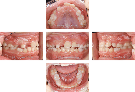 埋伏歯− 症例2の写真